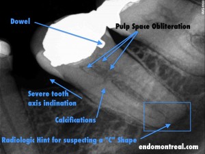 endomontreal dental clinic case study by Dr Pierre Pizem. Pre-Treatment Root Canal