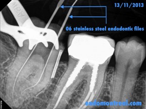 S Shape Root Canal Procedure (Per-Therapy)
