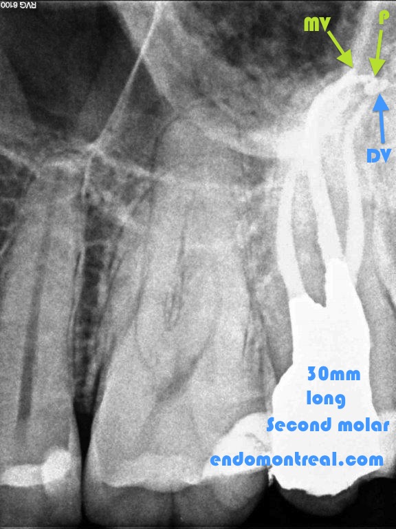 root canal with s curvature post-therapy
