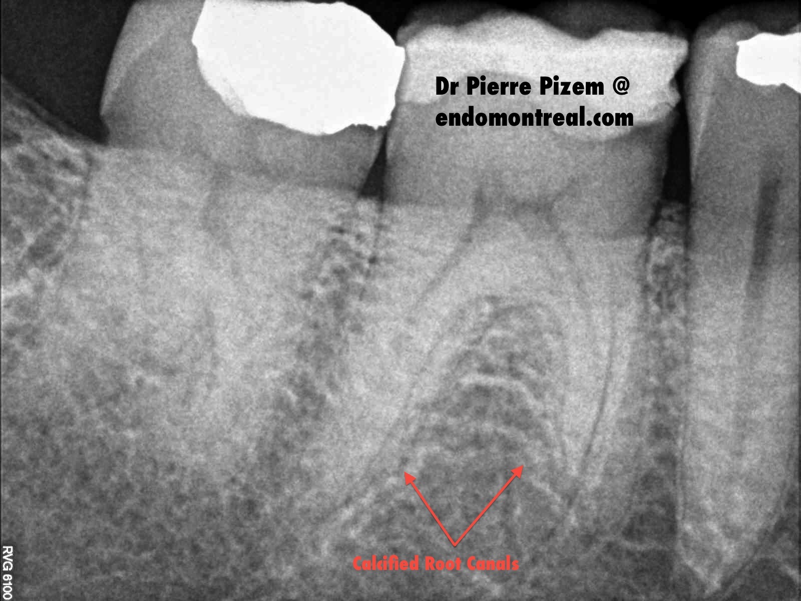 Root Canal Treatment on Calcified Molar Pre Therapy 46969-14