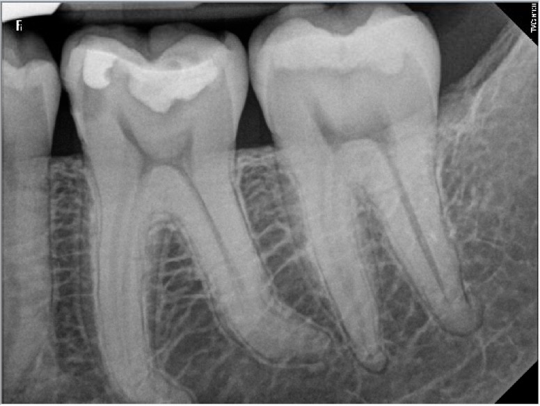 How to avoid a root canal treatment pre-therapy 14072015