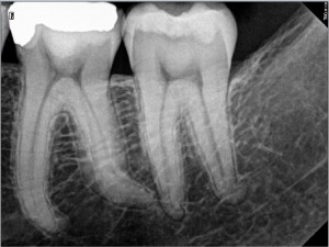 How to avoid a root canal therapy post treatment 20072015