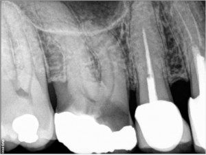 Root canal therapy on maxillary molar Pre operative 2015-08-27 1
