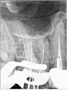 Root canal therapy on maxillary molar Per operative 2015-08-27 1 