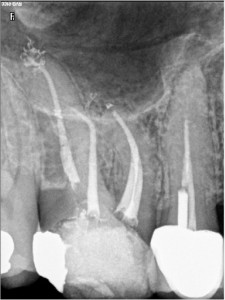 Root canal therapy on maxillary molar post operative 2015-08-27 1 