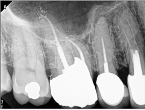 Root canal therapy on maxillary molar post and amalgam core build up 2015-08-27 1 