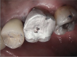 Tooth # 16 post operative post and core build up picture