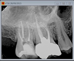 second mesiovestibular post root canal treatment A
