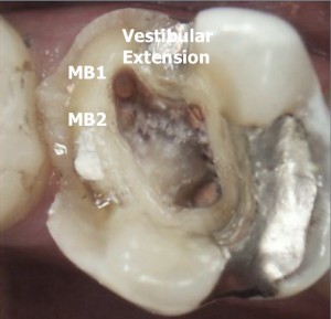 Calcified root canals picture MB2