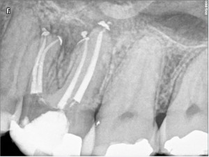 Calcified root canals post therapy
