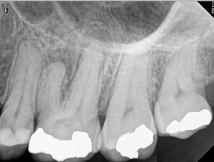 Calcified root canals pre therapy