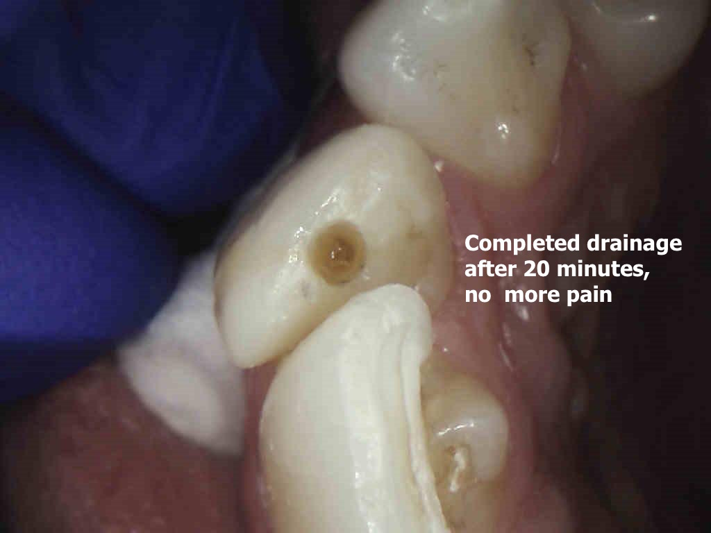 Ninja Access completed drainage through root canal treatment