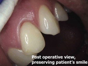 Preserving patient's smile