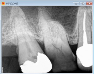 endodontist root canal pre therapy 14:10:2015