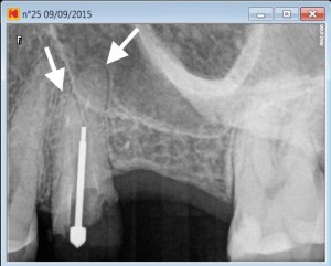 root canal 25 per therapy casted post removal