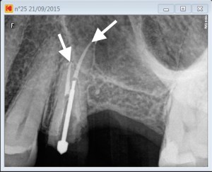 25 post therapy completed root canal revision procedure