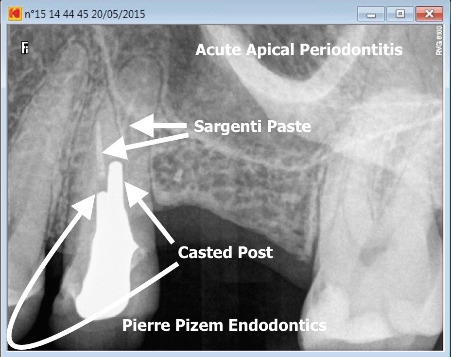 25 root canal revision pre therapy
