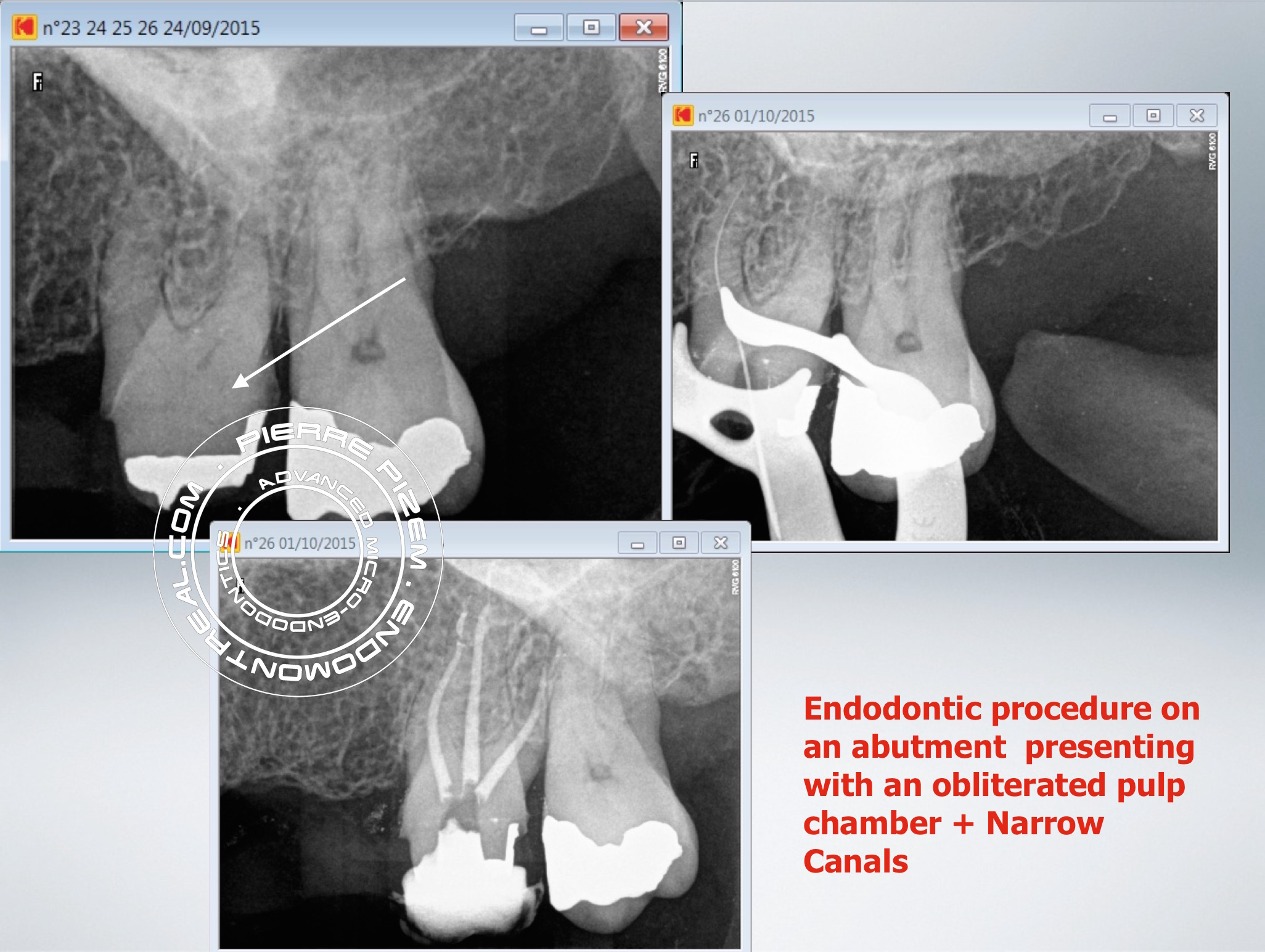 root canal procedure on a calcified molar abutment