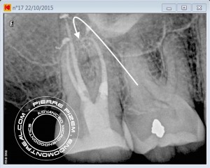 Severe root canal curvature 17 post operative