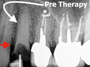 24 Pre Root Canal Therapy