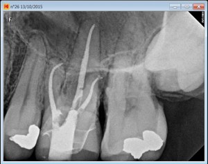 26 calcified MB2 Ca(OH)2 post root canal procedure