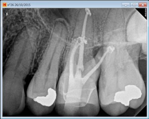 26 calcified MB2 post root canal procedure