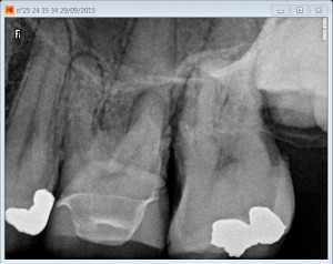 26 calcified MB2 pre root canal procedure