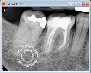46 dilaceration post root canal therapyB