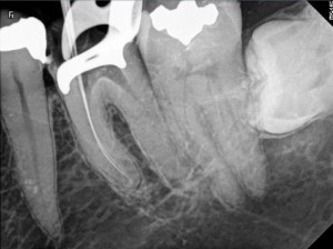 Root Canal Procedure Calcified Tooth 36 per therapy A