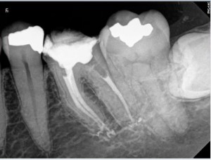 Root Canal Procedure Calcified Tooth 36 post therapy
