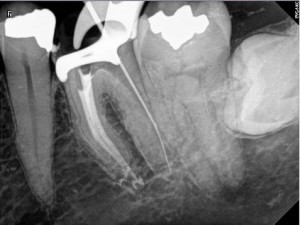 Root Canal Procedure Calcified Tooth 36 pre therapy B