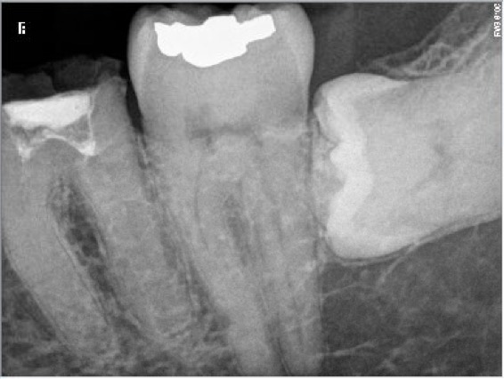 Root Canal Procedure Calcified Tooth 36 pre therapy at 10.38.42 AM