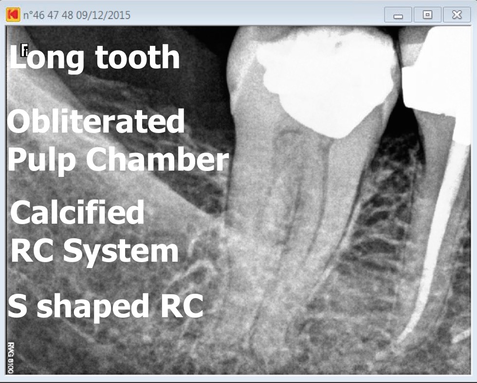 47 calcified tooth root canal procedure pre therapy 2016-01-13