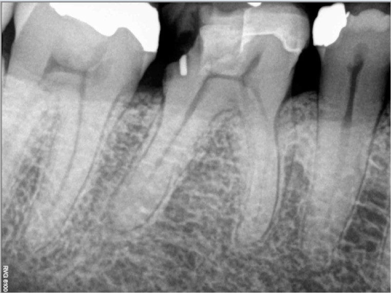 46 calcified Pre operative 2016-01-28