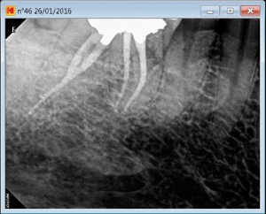 46 calcified C 2016-01-28