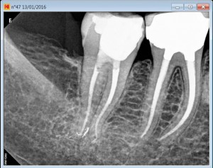 47 calcified tooth root canal procedure post therapy 2016-01-13 