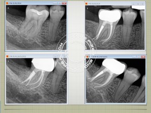 One canal and three portals of exit in distal root 46