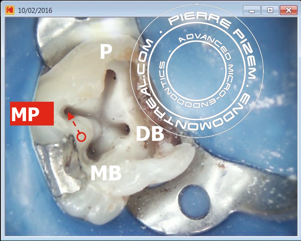 Root canal procedure on a maxillary molar presenting with a supernumerary palatal root