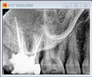 17 second palatal canal Ca(OH)2