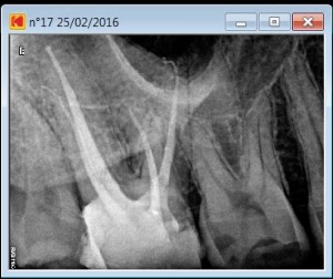 17 second palatal canal post operative