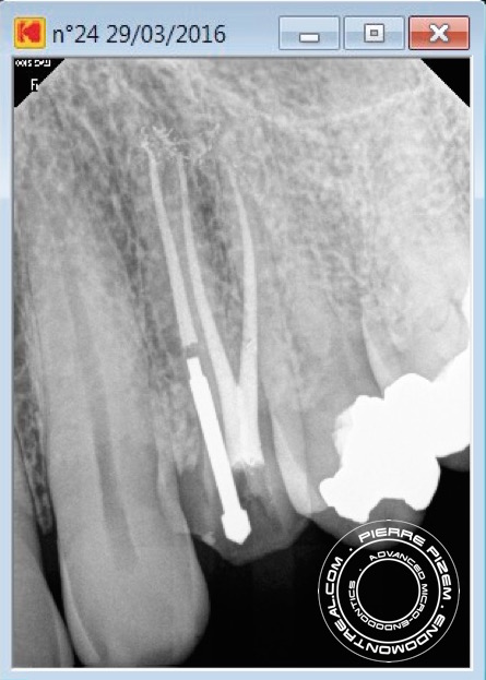 Tooth 24 long calcified 3 rooted tooth post operative 2016-03-29