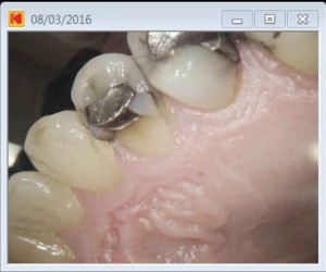 Tooth 24 pre operative fractured cusp 2016-03-29