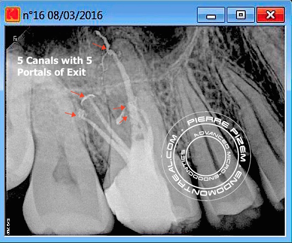 2MB root canal 2DB root canal1P root canal Post operative 2016-03-08