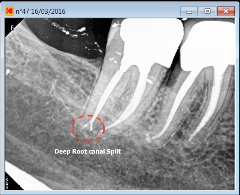 A distal root canal with an apical delta ENDOMONTREAL