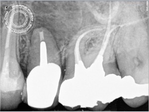 26 calcified Post Operative 2016-04-12 root canal treatment