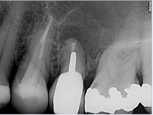 26 calcified Pre Operative 2016-04-12 root canal treatment