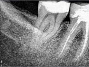 47 root canal treatment pre therapy 2016-04-18