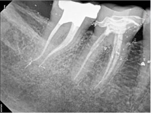 47 B root canal treatment post therapy B 2016-04-18
