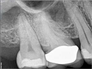 Root Canal therapy 16 calcified A 2016-05-09