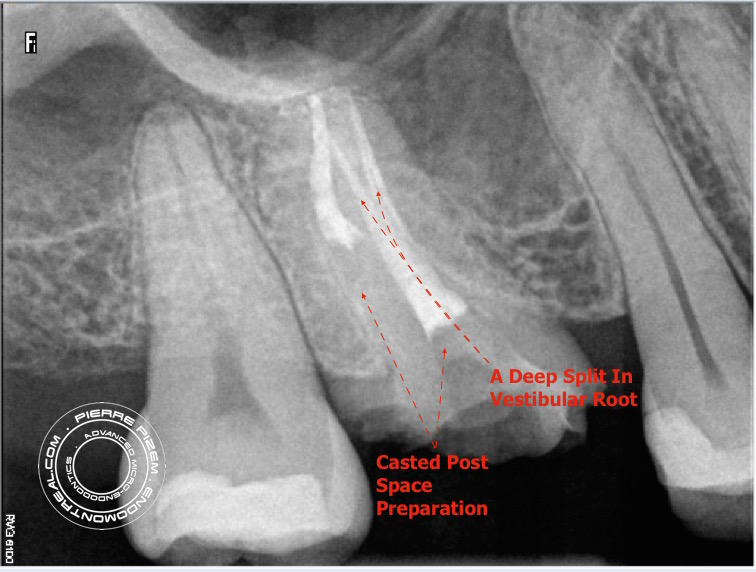 Root Canal therapy 16 calcified B 2016-05-09